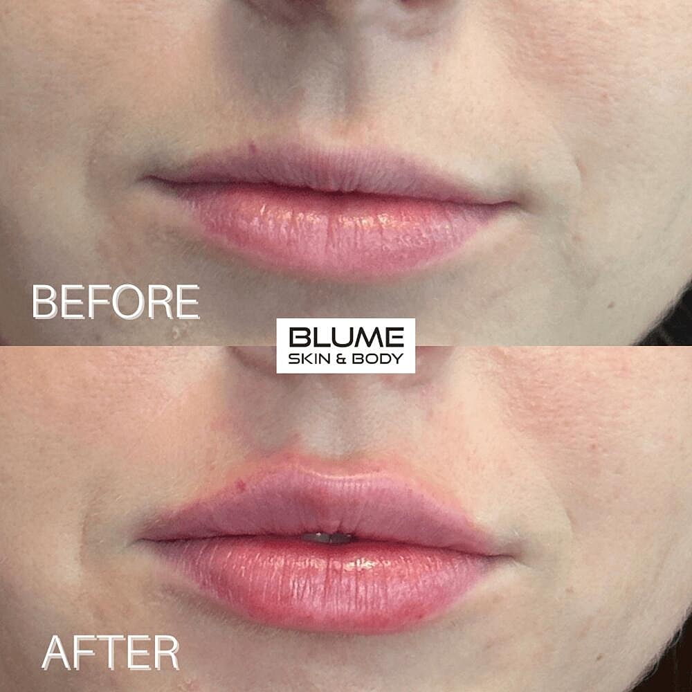 Dermal Fillers Before & After