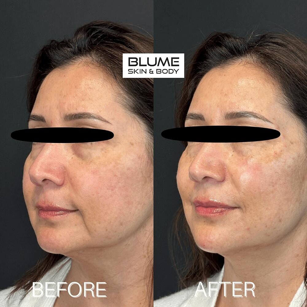 Dermal Fillers Before & After