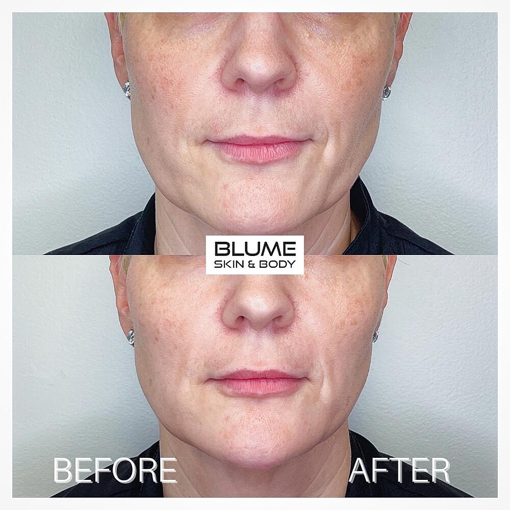 Dermal Fillers Before & After