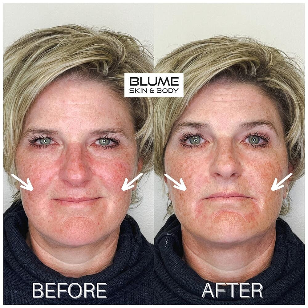 Dermal Fillers Before & After