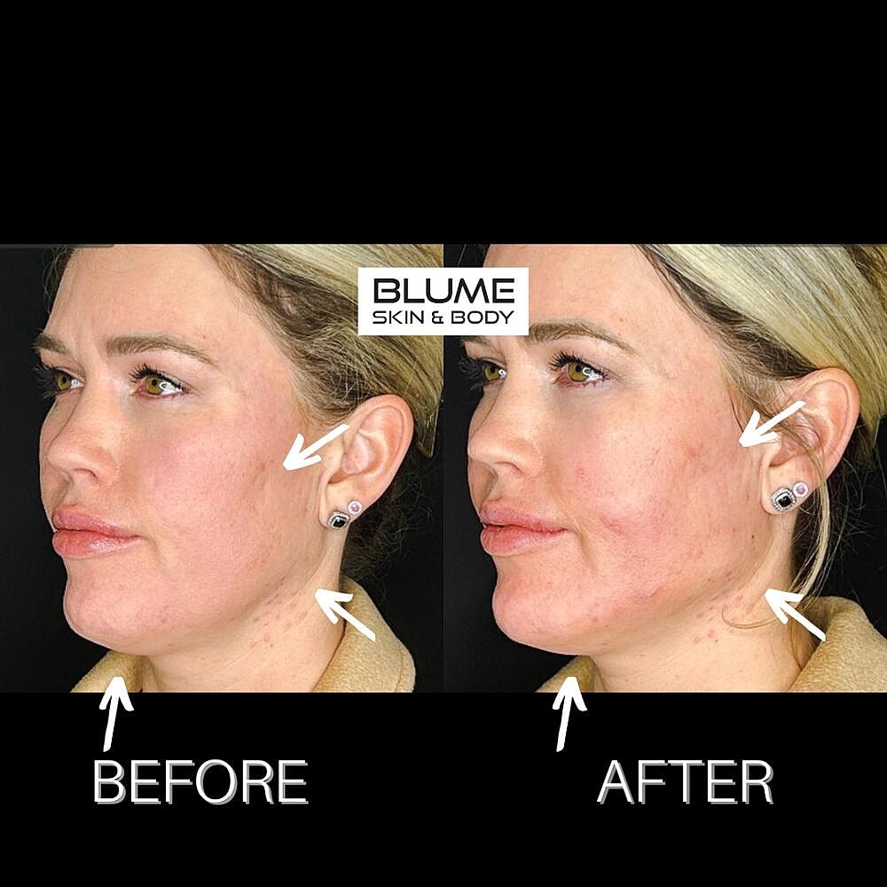 Dermal Fillers Before & After