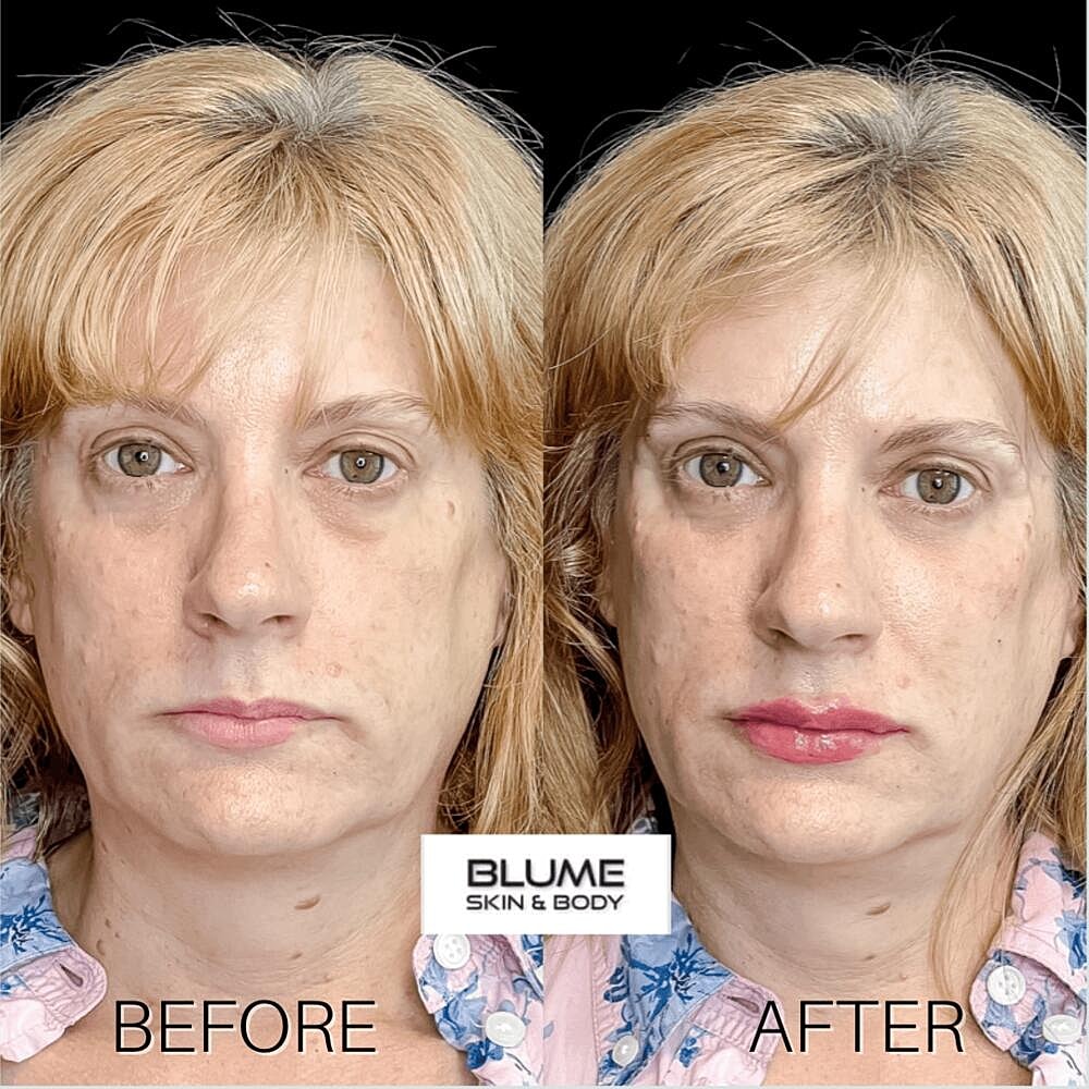 Dermal Fillers Before & After