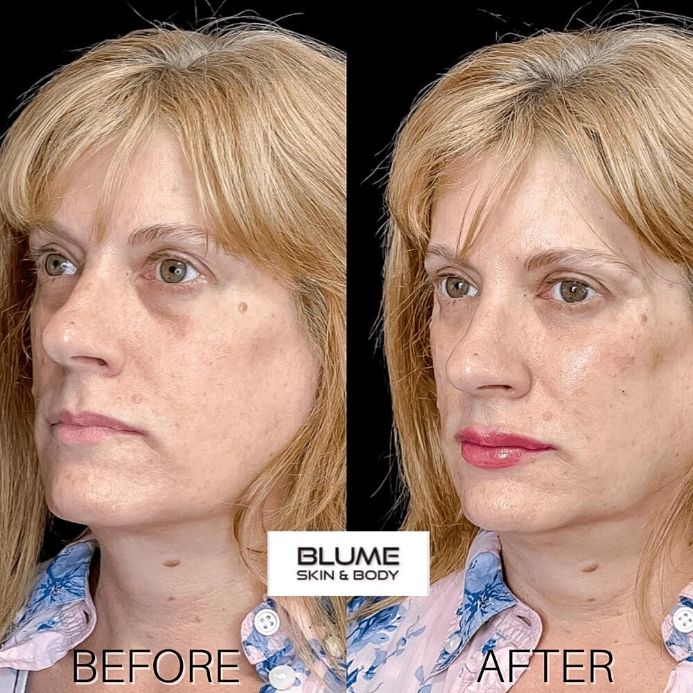 Dermal Fillers Before & After