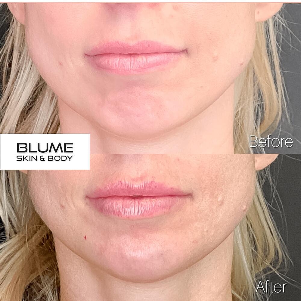 Dermal Fillers Before & After