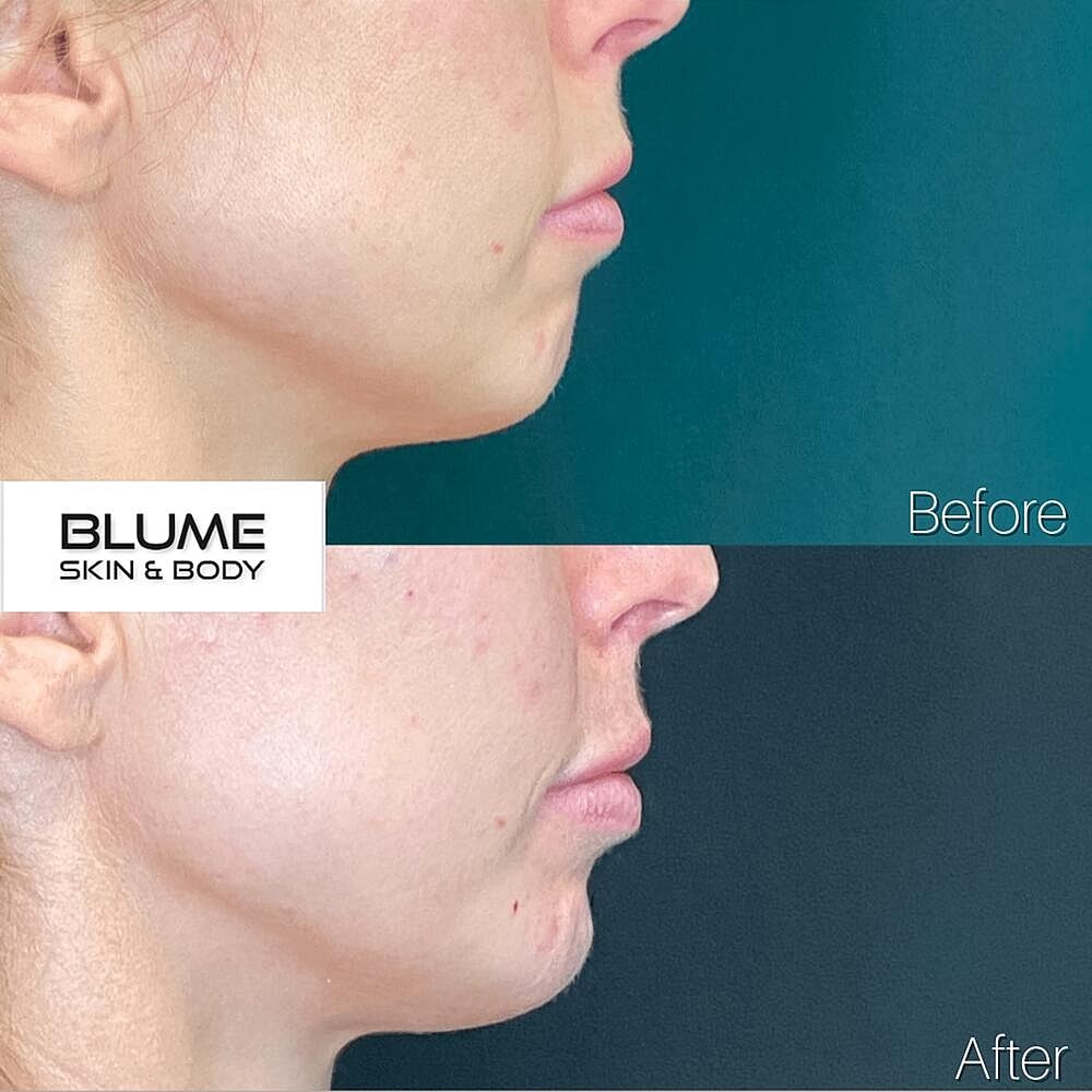 Dermal Fillers Before & After