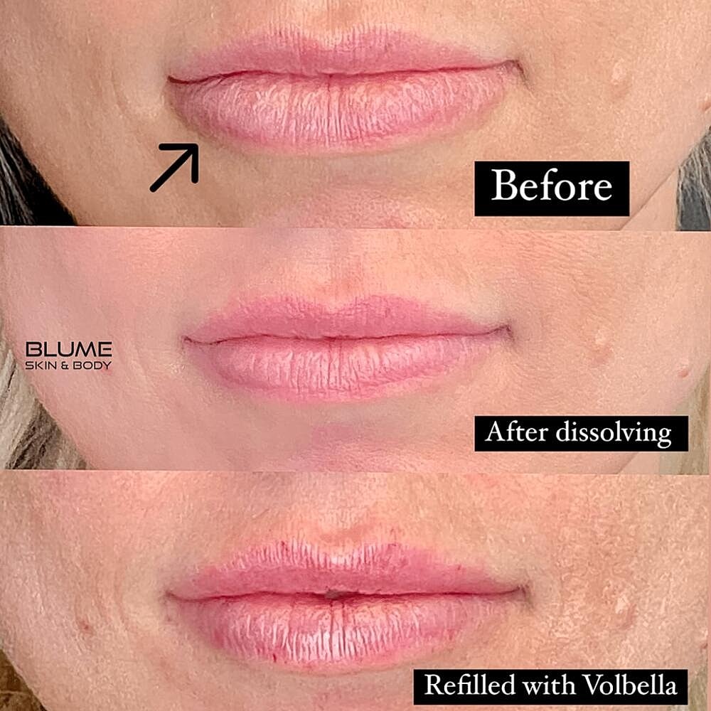 Dermal Fillers Before & After