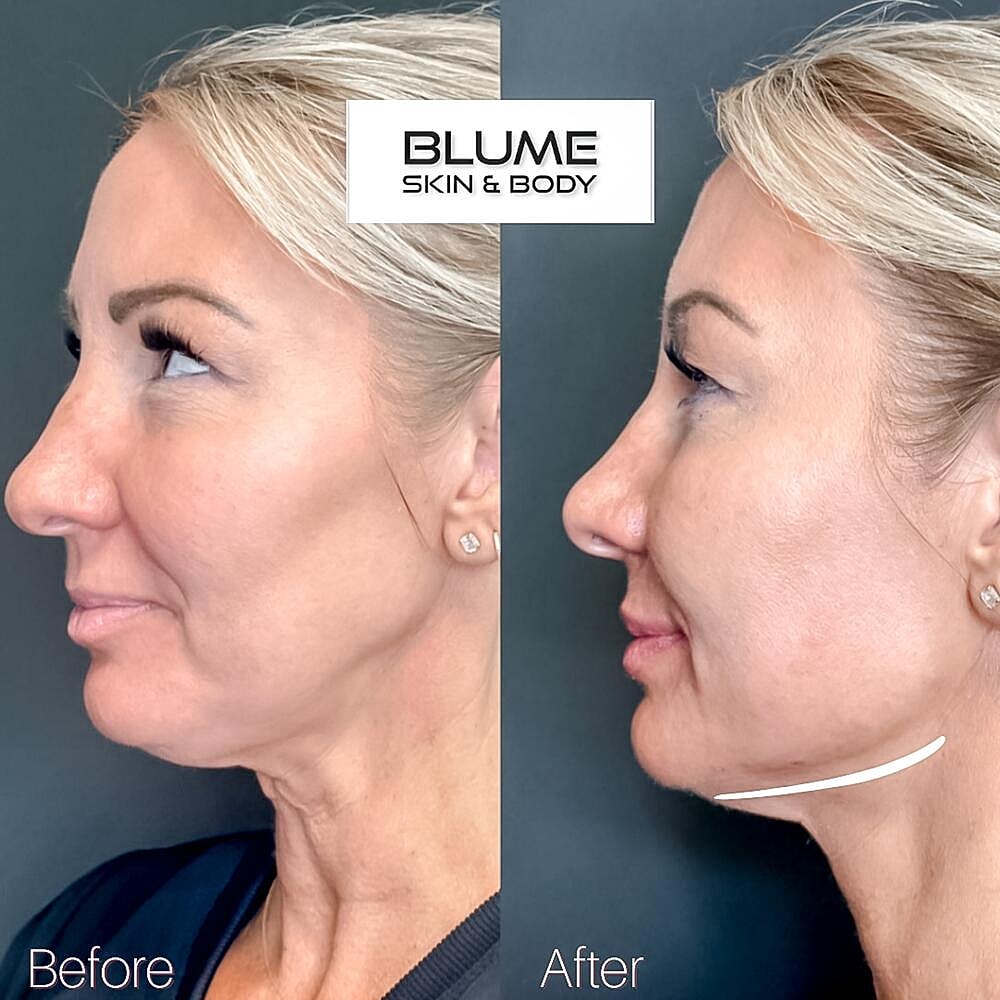 Dermal Fillers Before & After