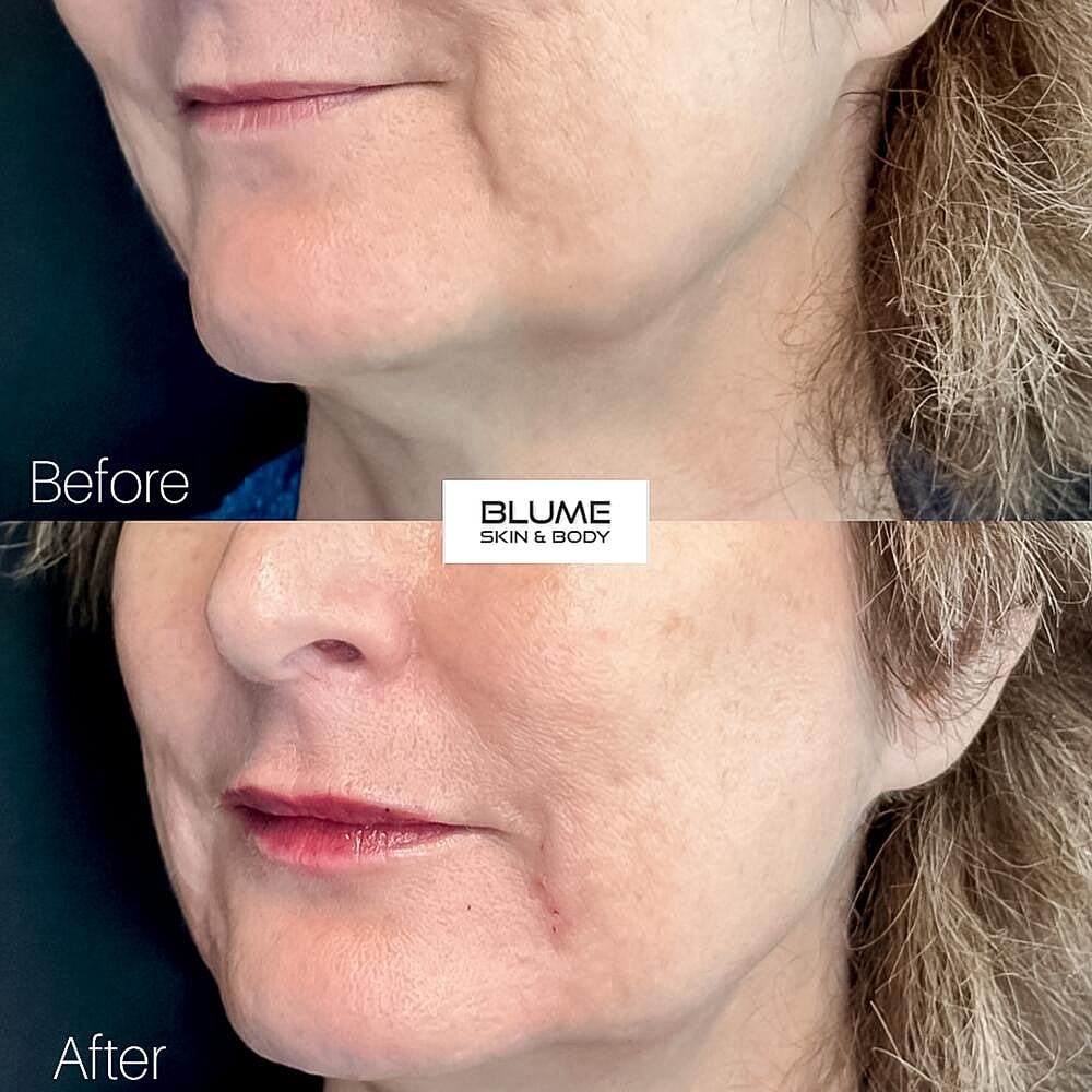 Dermal Fillers Before & After