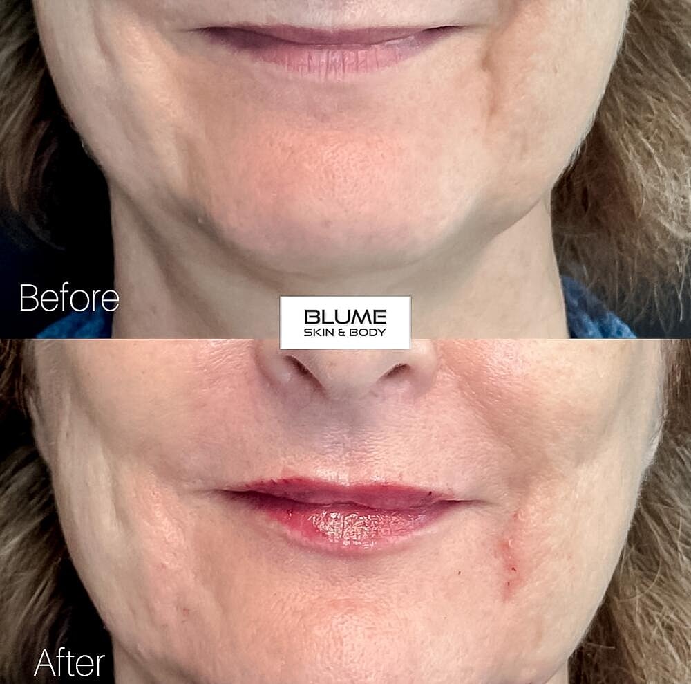 Dermal Fillers Before & After
