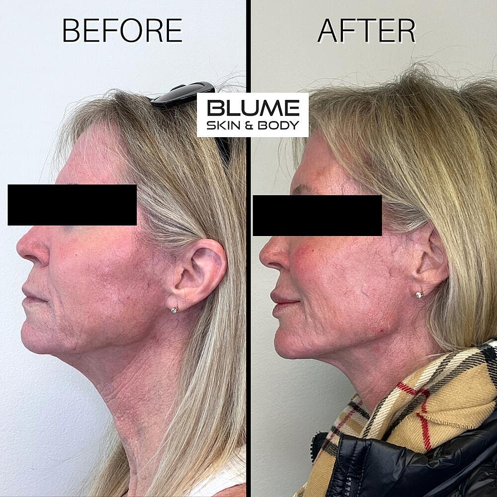Dermal Fillers Before & After