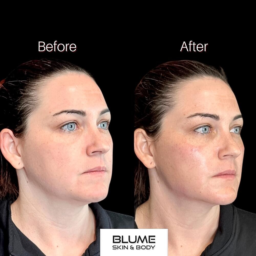 Dermal Fillers Before & After