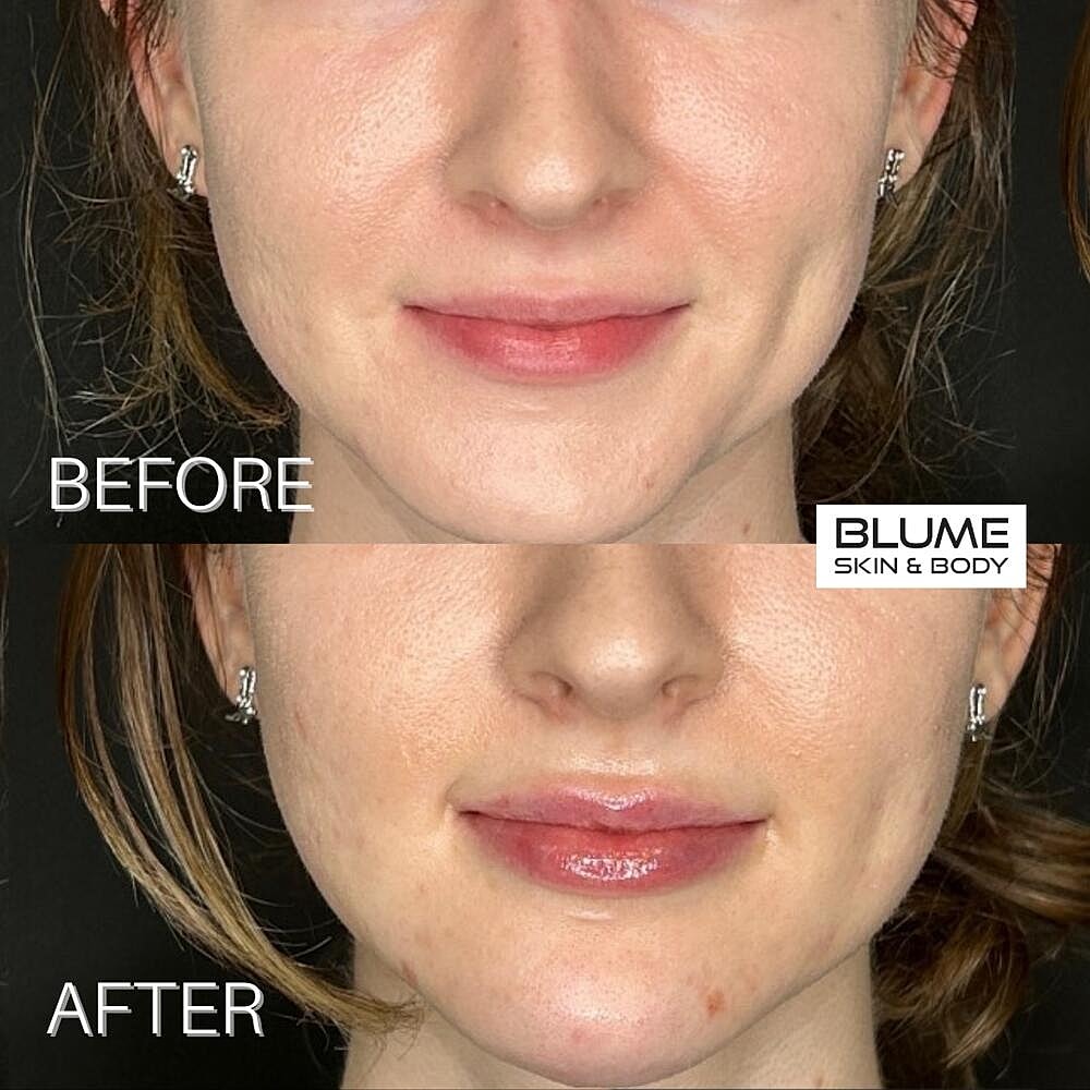 Dermal Fillers Before & After