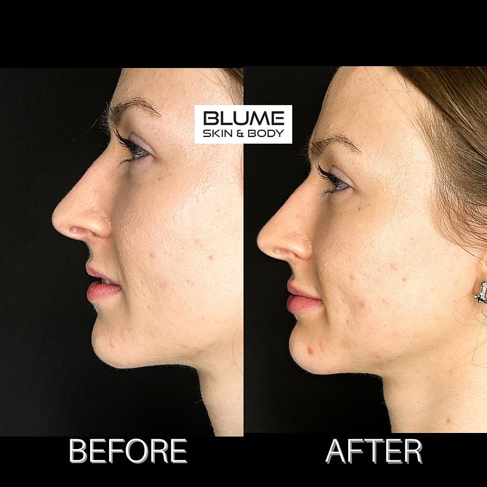 Dermal Fillers Before & After
