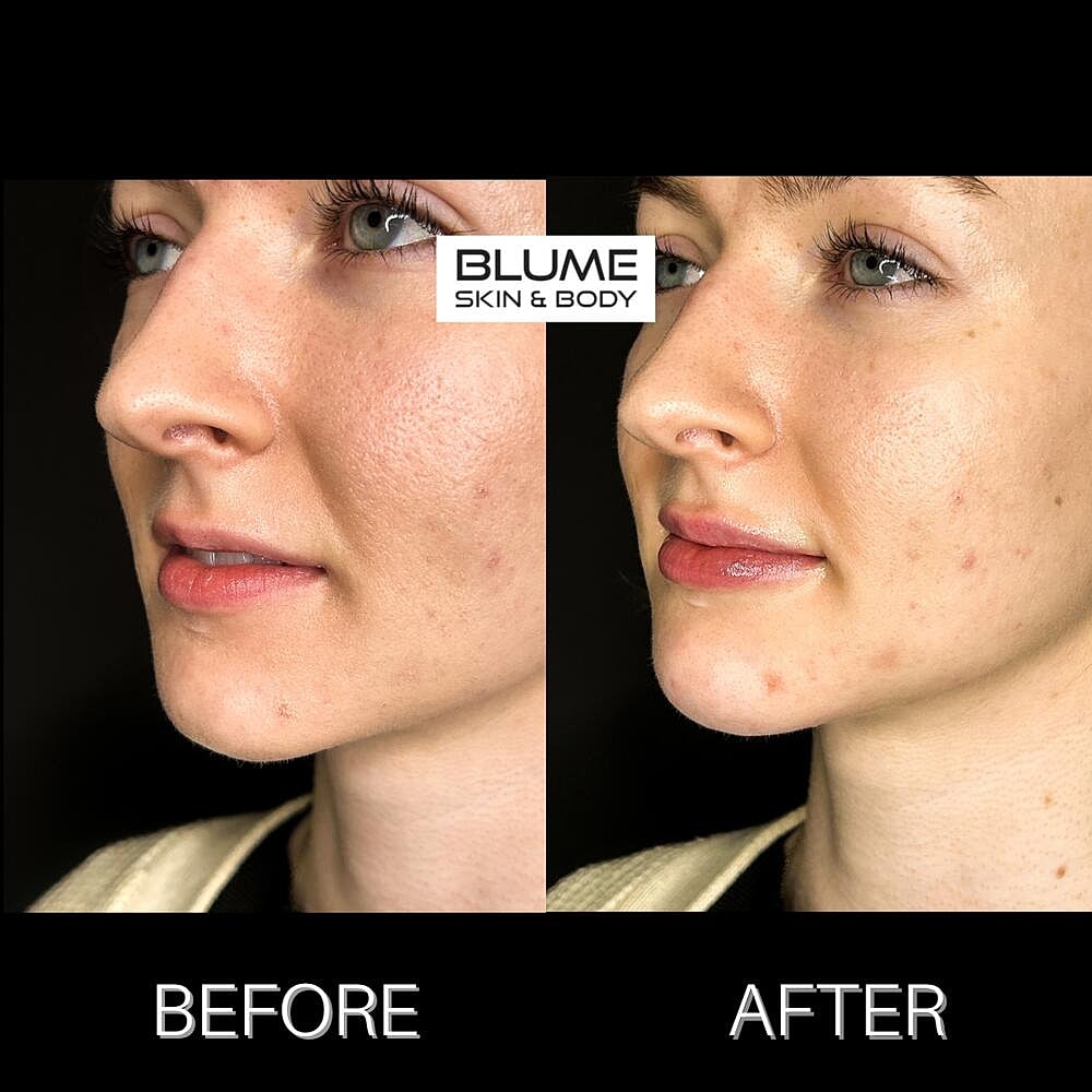 Dermal Fillers Before & After