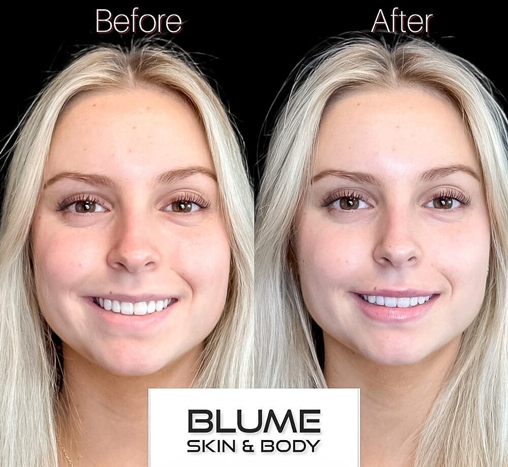 Dermal Fillers Before & After