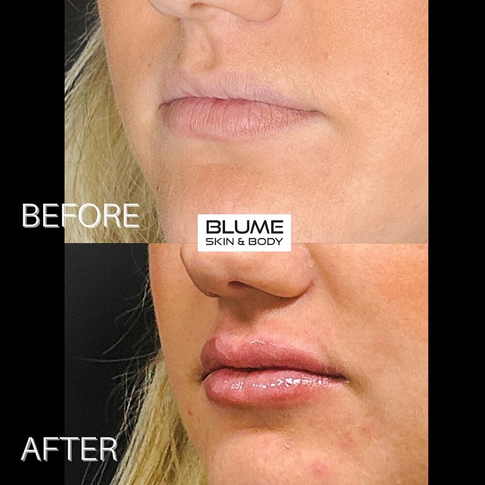 Dermal Fillers Before & After