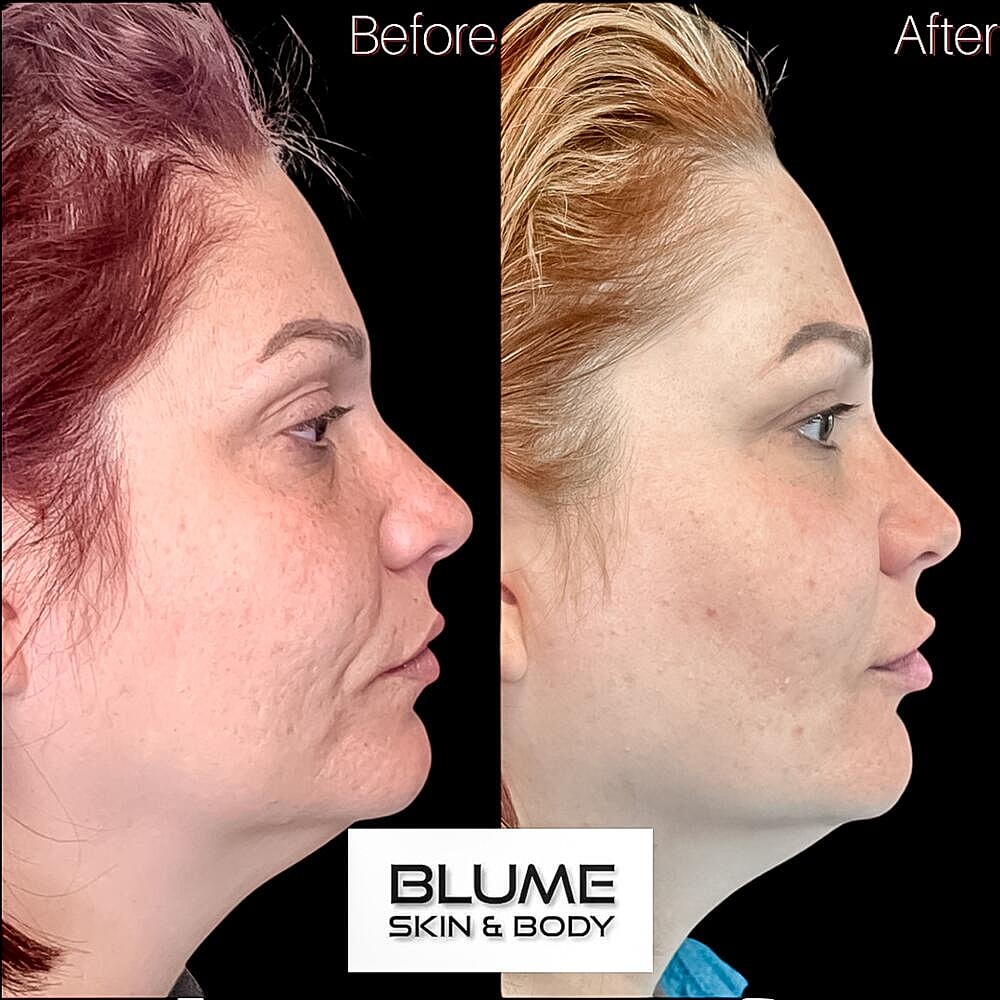 Dermal Fillers Before & After