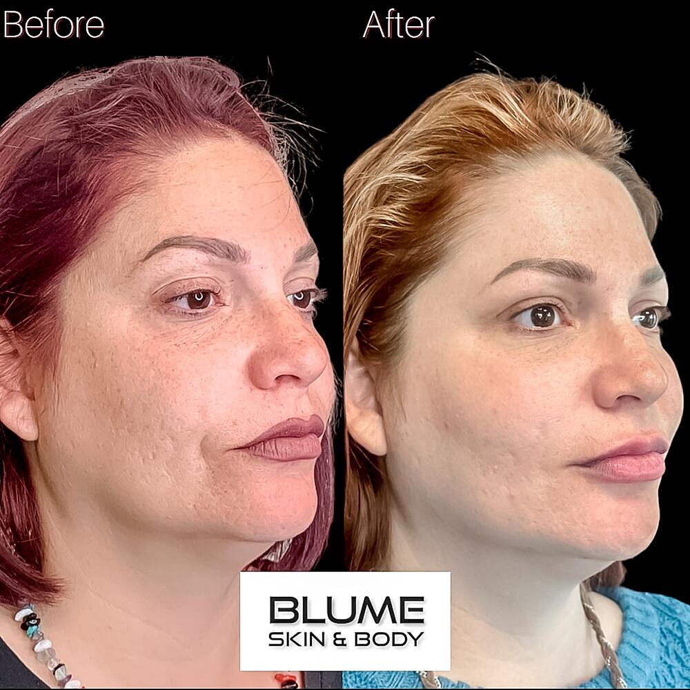 Dermal Fillers Before & After