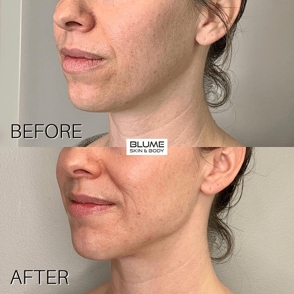 Dermal Fillers Before & After