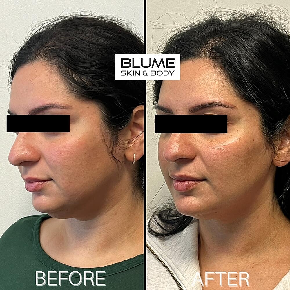 Dermal Fillers Before & After