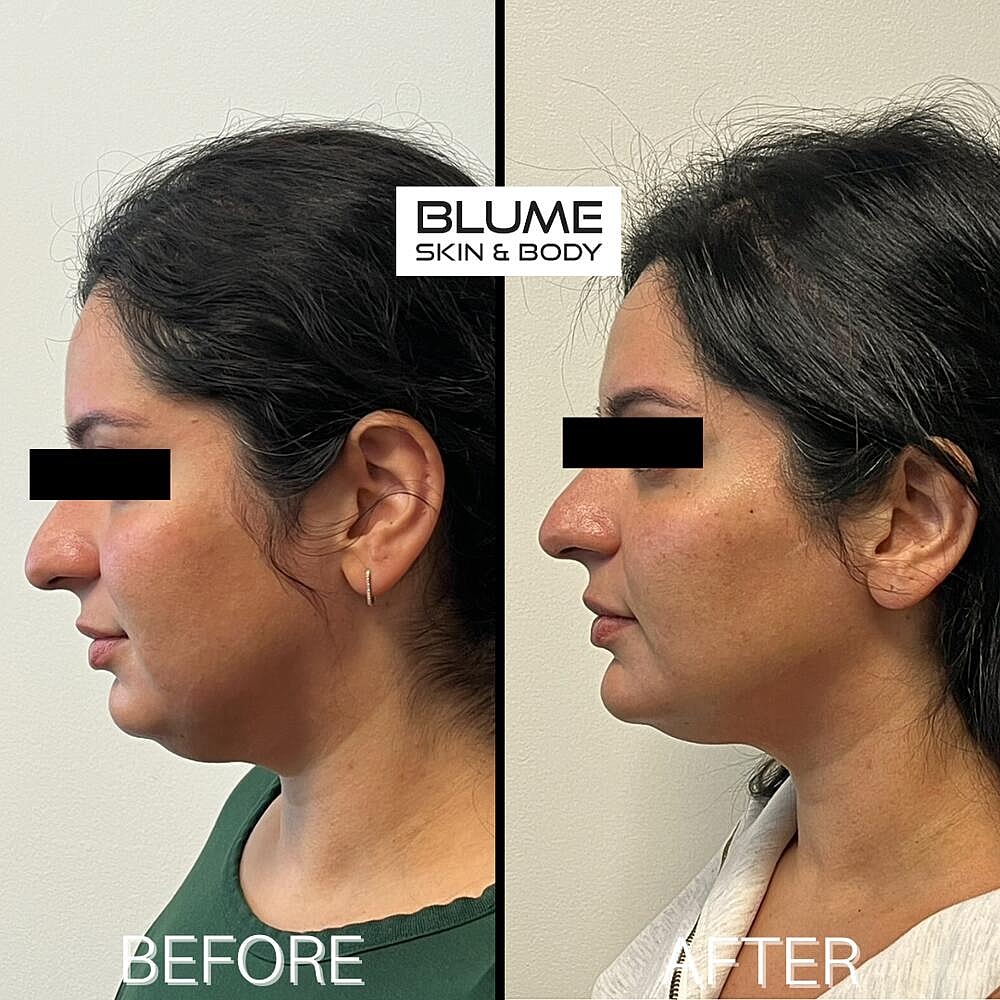 Dermal Fillers Before & After