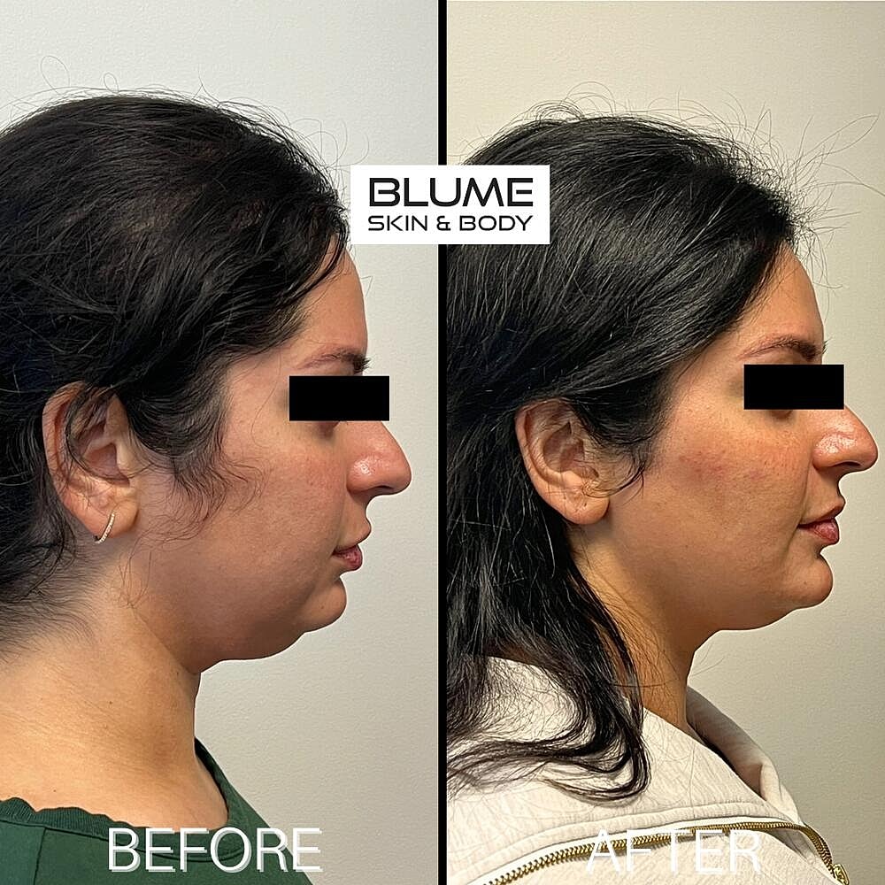 Dermal Fillers Before & After