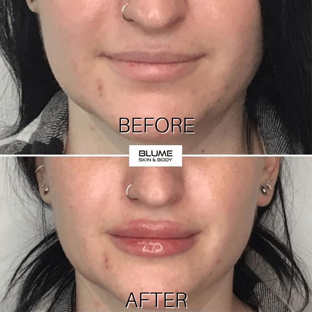 Dermal Fillers Before & After