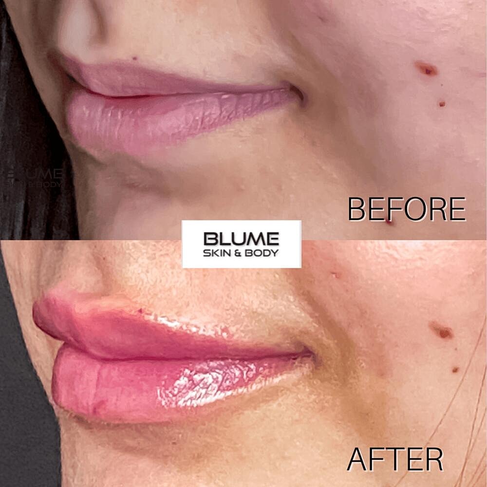 Dermal Fillers Before & After