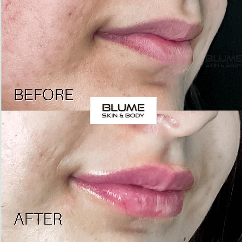 Dermal Fillers Before & After
