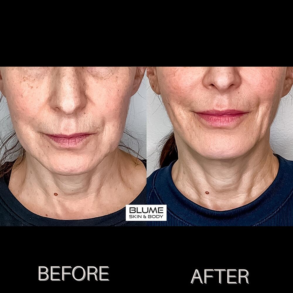 Dermal Fillers Before & After
