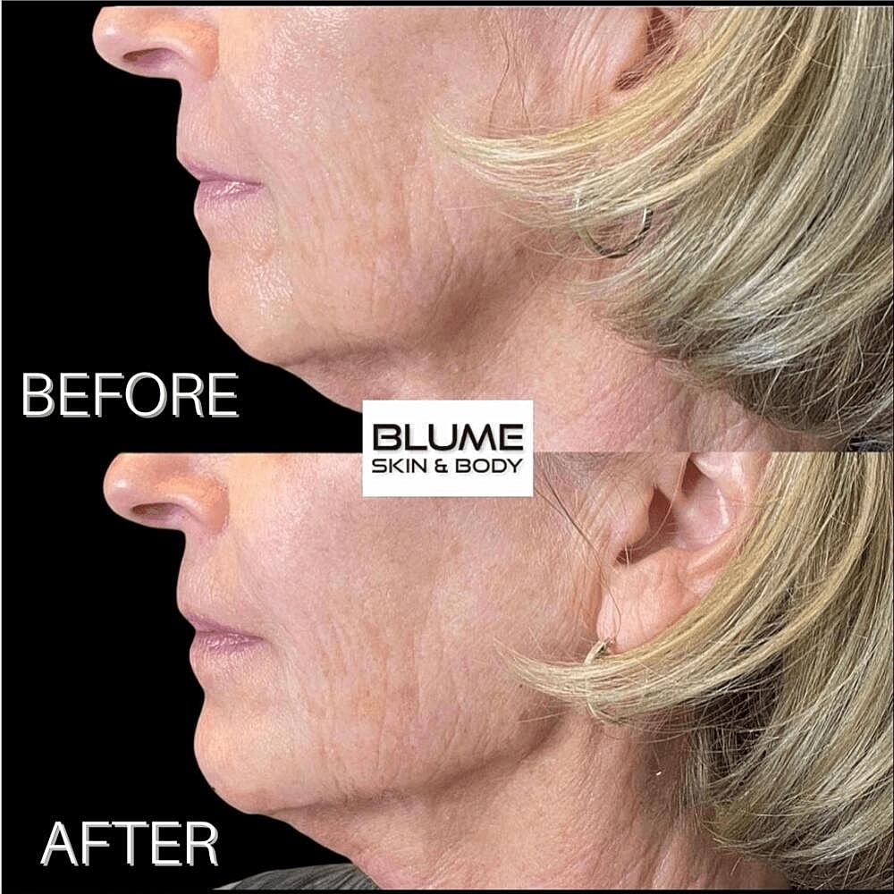 Dermal Fillers Before & After