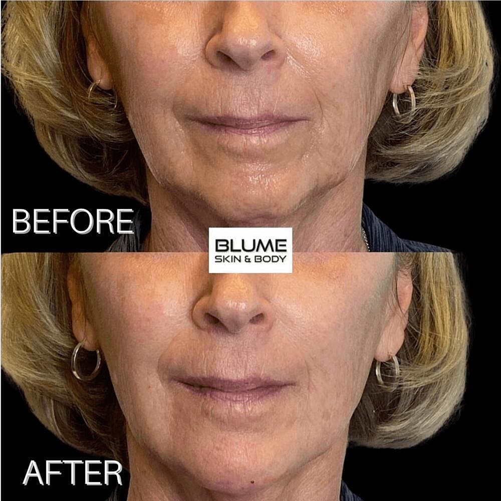Dermal Fillers Before & After