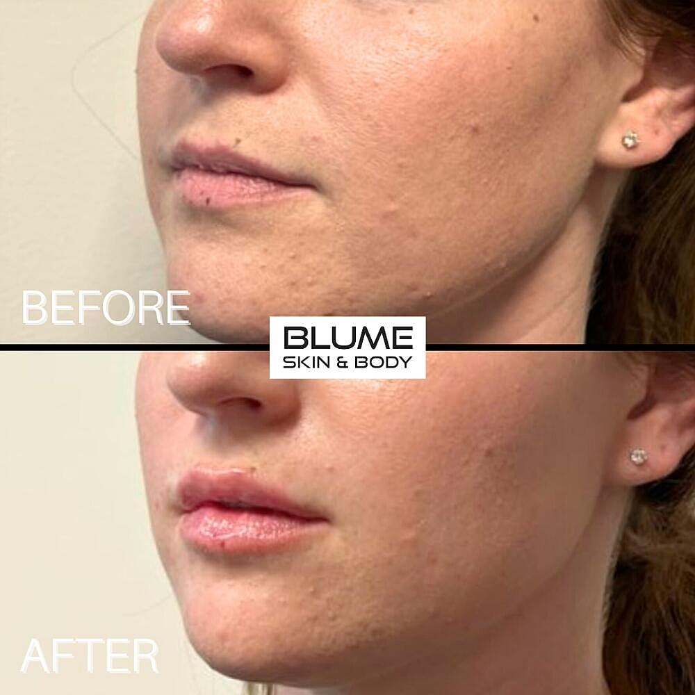 Dermal Fillers Before & After