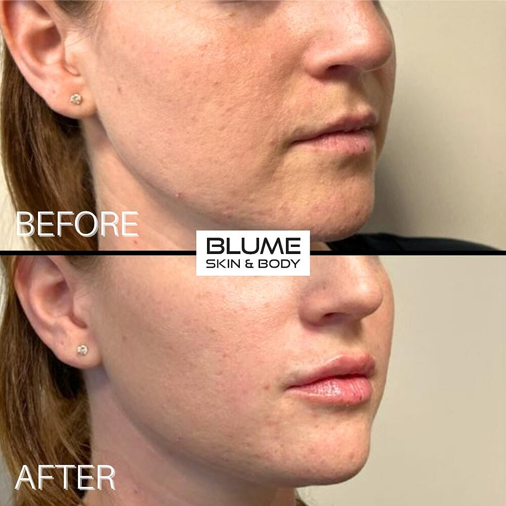 Dermal Fillers Before & After