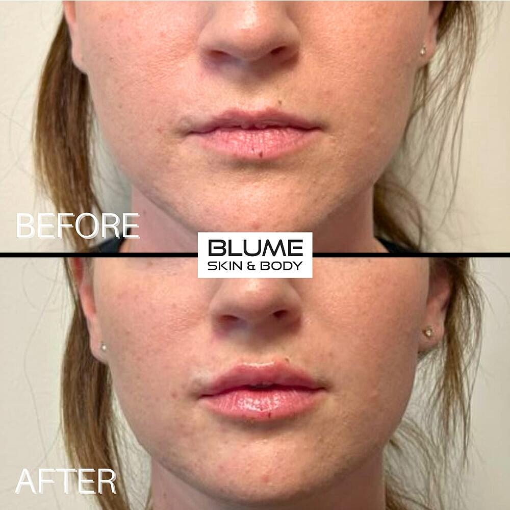 Dermal Fillers Before & After