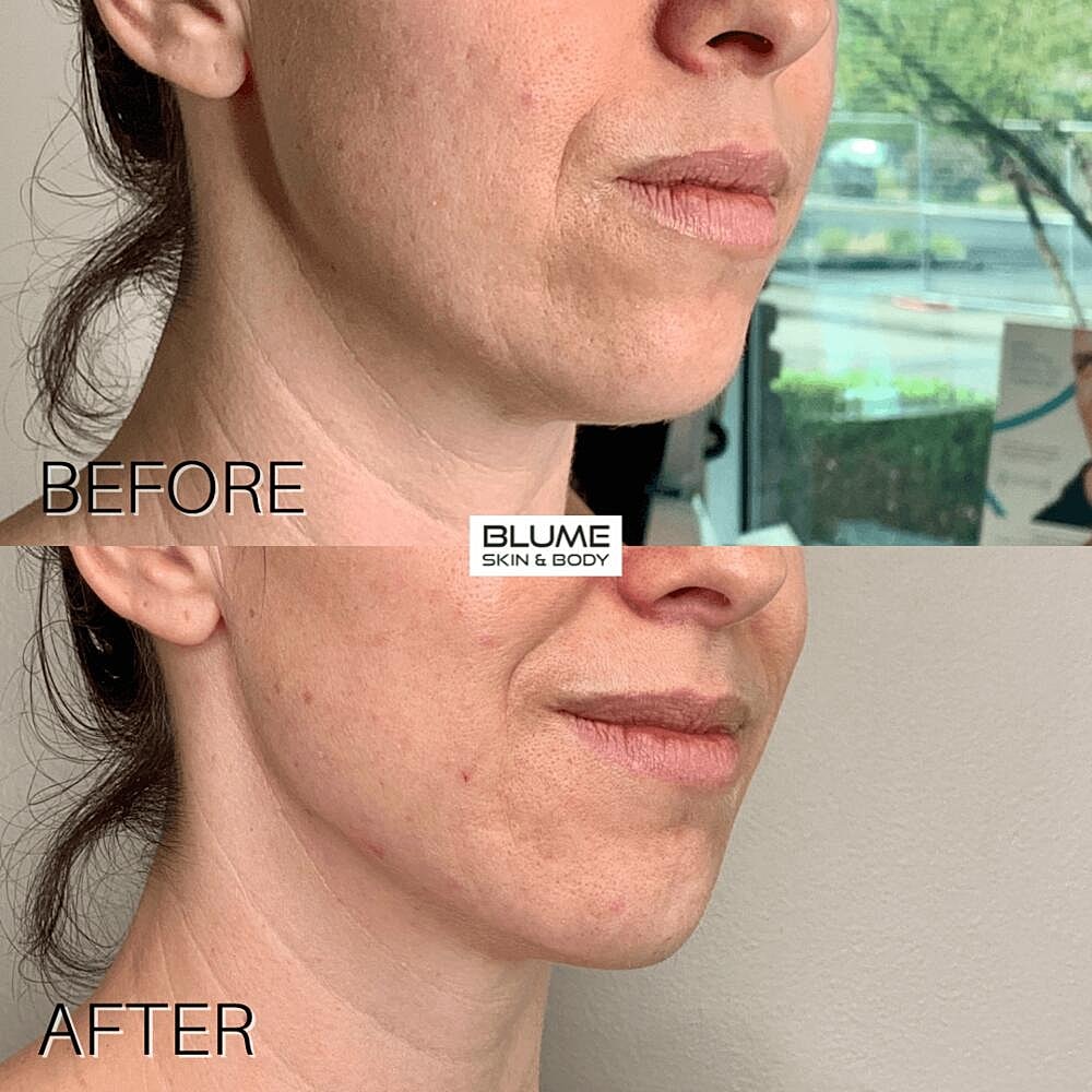 Dermal Fillers Before & After