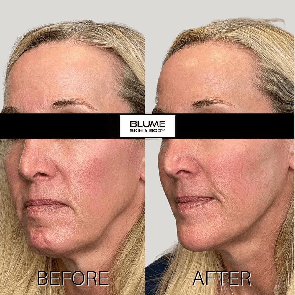 Dermal Fillers Before & After