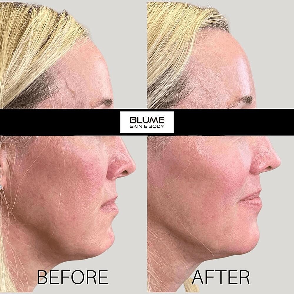 Dermal Fillers Before & After
