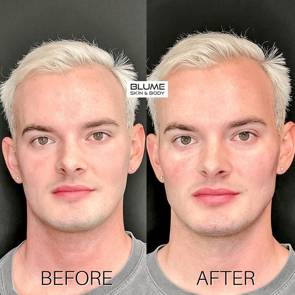 Dermal Fillers Before & After