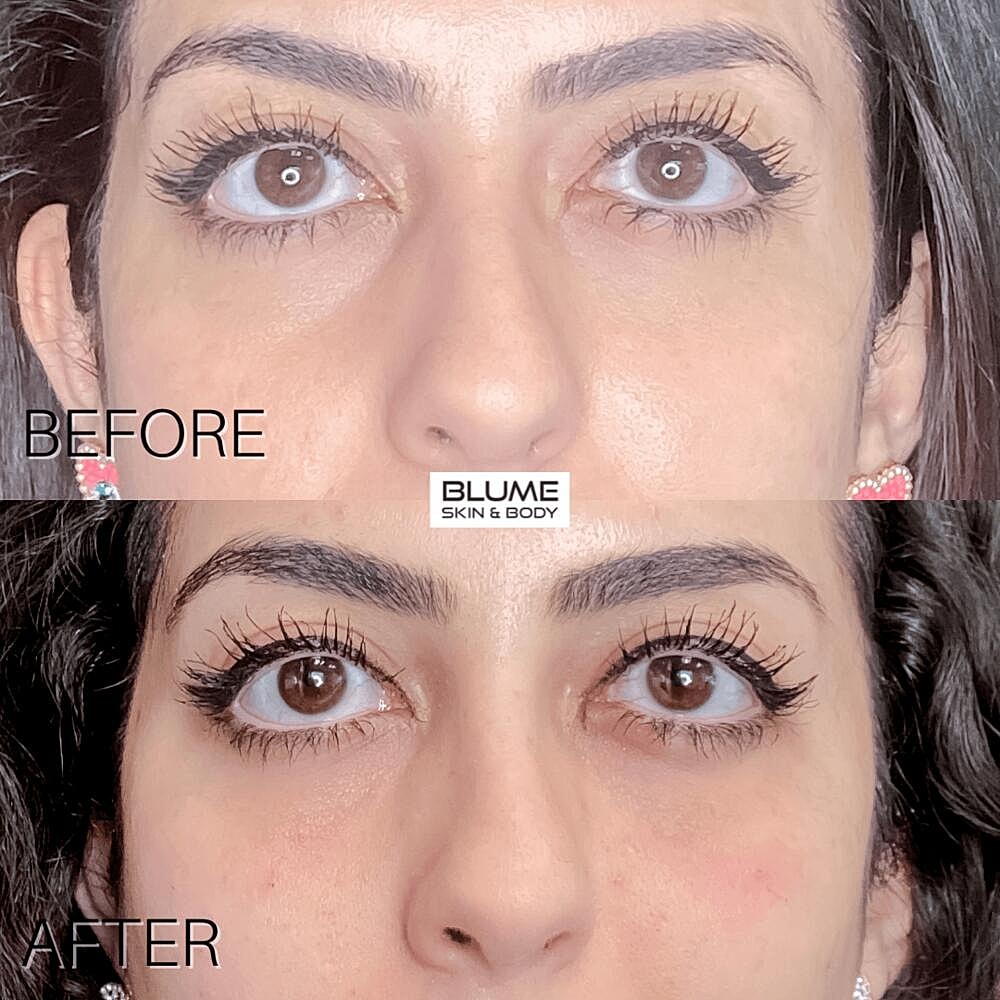 Dermal Fillers Before & After