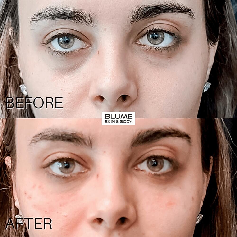 Dermal Fillers Before & After