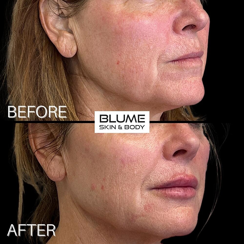 Dermal Fillers Before & After