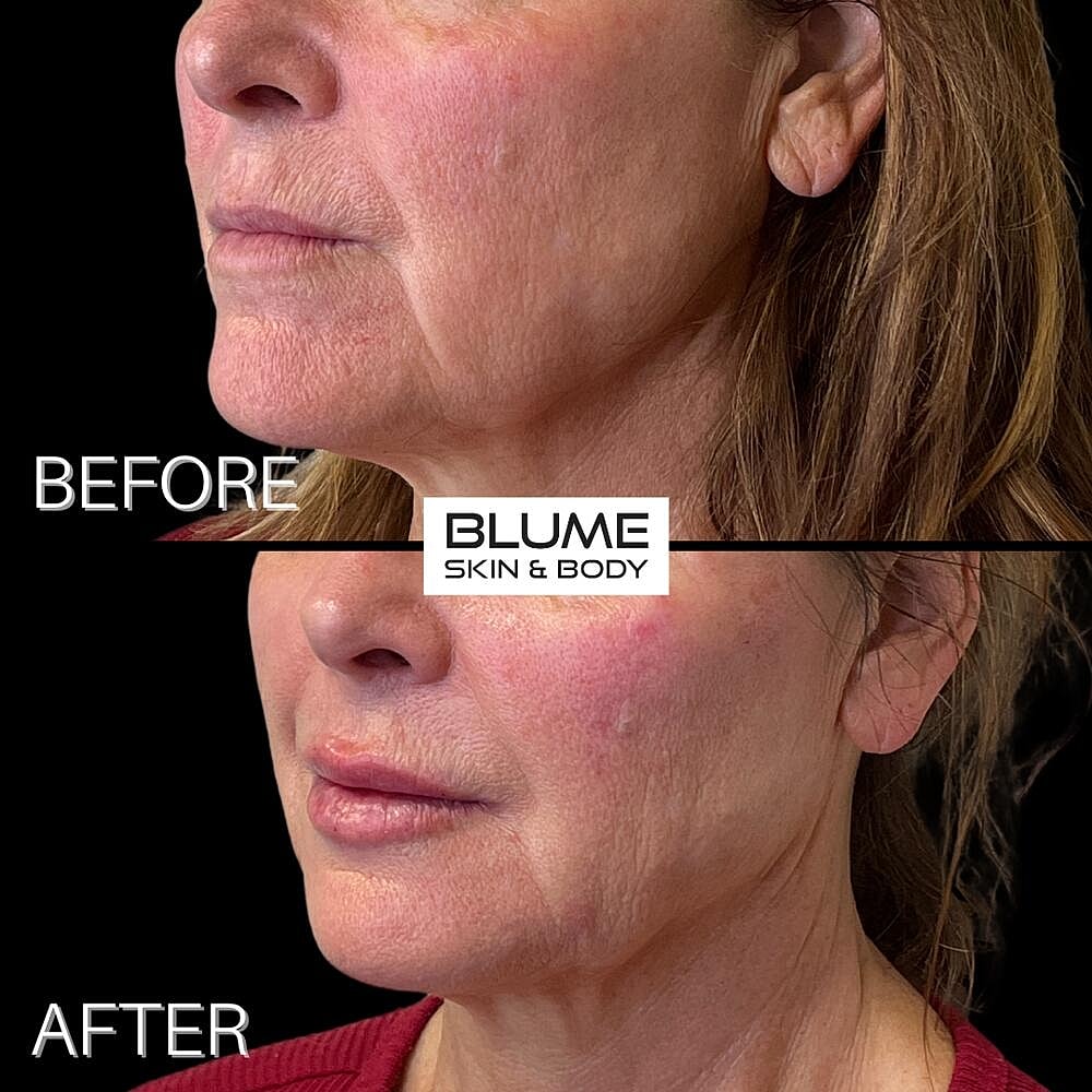 Dermal Fillers Before & After