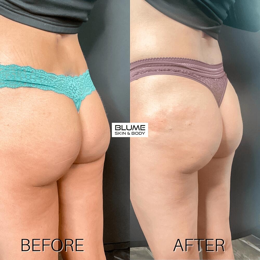 Dermal Fillers Before & After