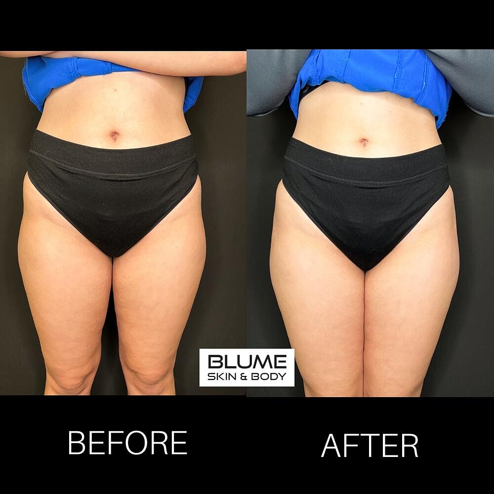 Dermal Fillers Before & After