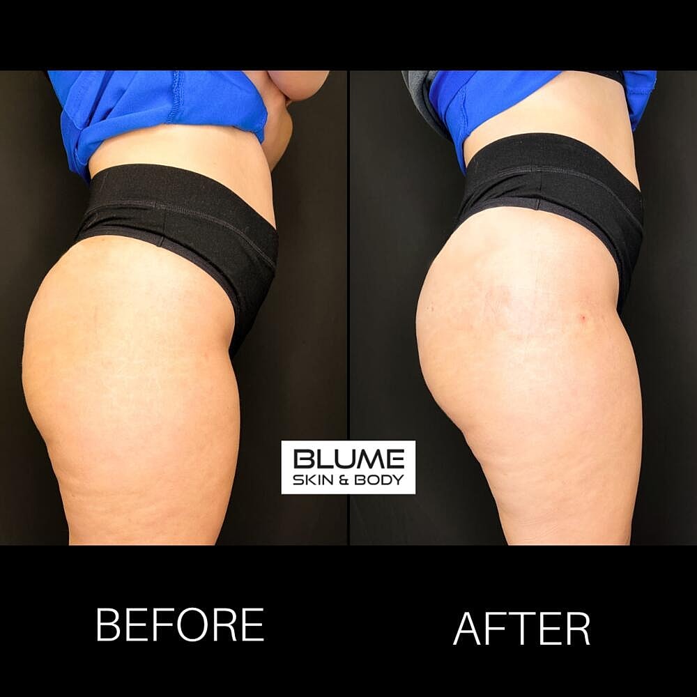 Dermal Fillers Before & After