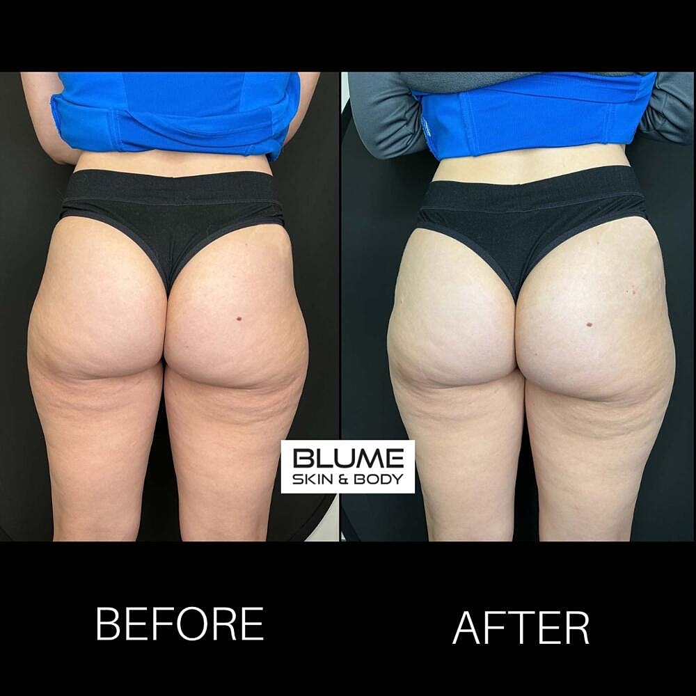 Dermal Fillers Before & After