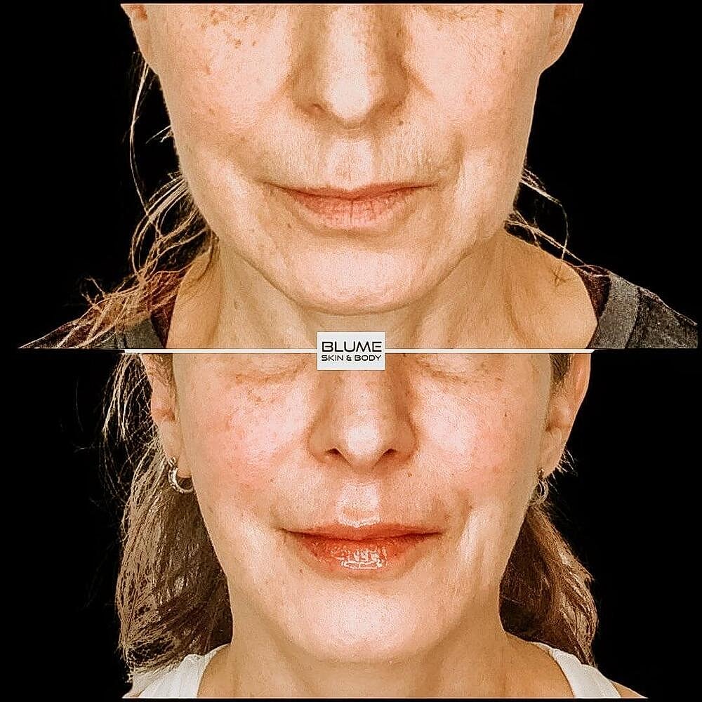 Dermal Fillers Before & After