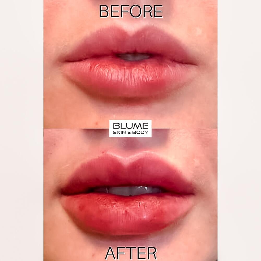 Dermal Fillers Before & After