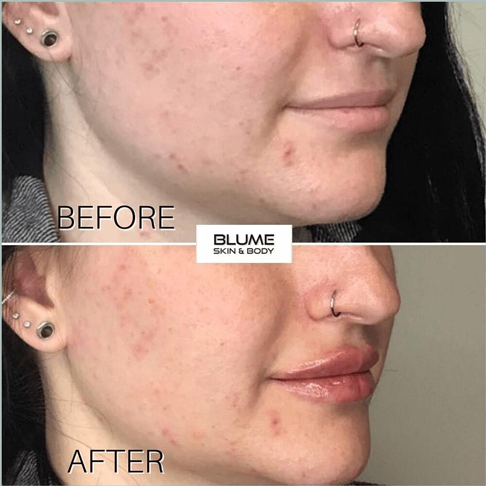 Dermal Fillers Before & After